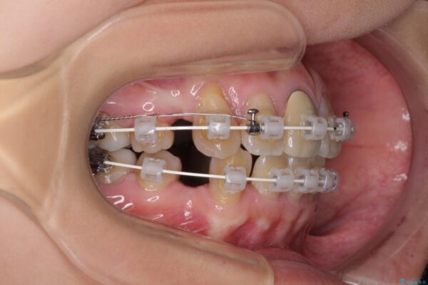 八重歯とクロスバイト　目立たないワイヤー装置での抜歯矯正 治療途中画像