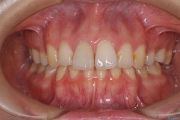 部分矯正を併用した奥歯のインプラント治療 治療前画像