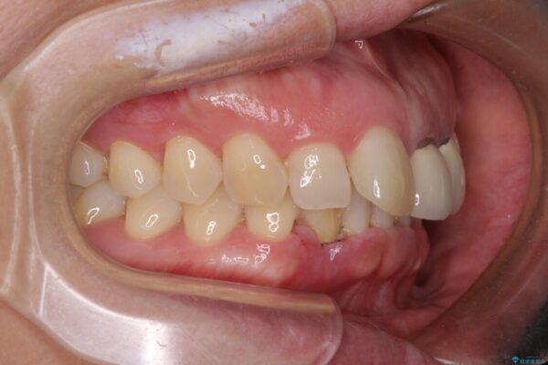 前歯のインプラント治療　折角なので矯正治療できれいな歯並びに 治療前画像