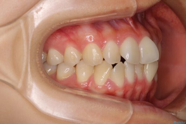 前歯のクロスバイト　ワイヤー装置を併用したインビザライン矯正 治療前画像