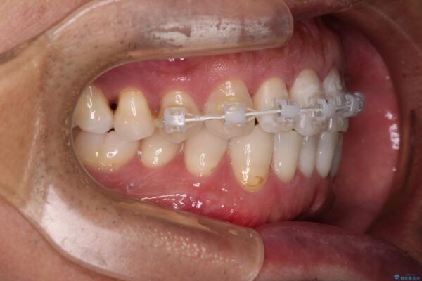内側にある歯が干渉する　上顎前歯の部分矯正 治療途中画像