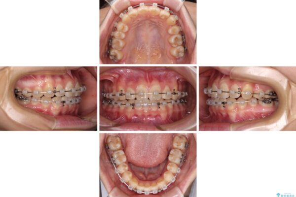 目立つ八重歯を治したい　インビザラインによる矯正治療 治療途中画像