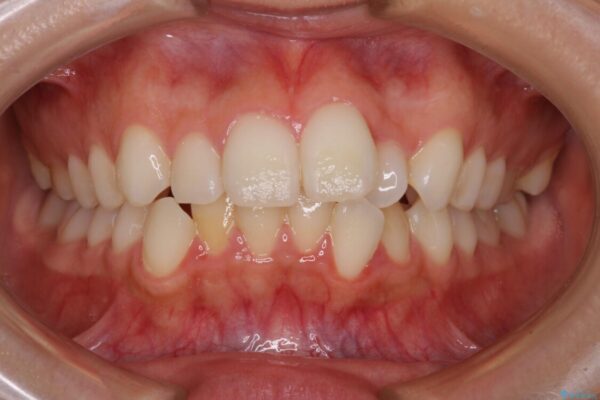 【モニター】前歯のクロスバイトをインビザラインで治療 治療前画像