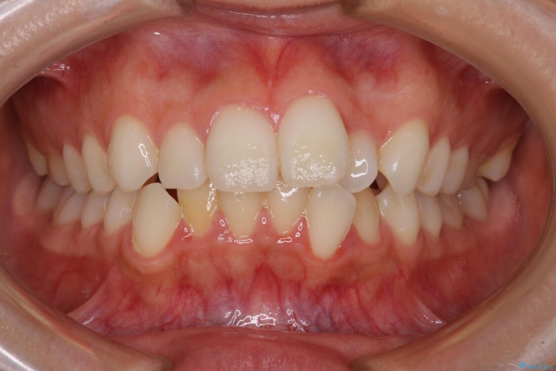 【モニター】前歯のクロスバイトをインビザラインで治療 治療前