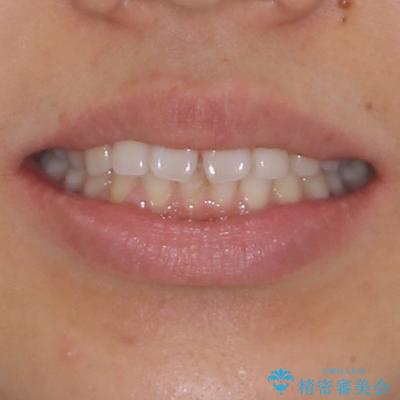 隙間の空いた前歯を閉じたい　インビザライン矯正 治療前画像