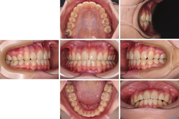 目立つ八重歯を治したい　インビザラインによる矯正治療 治療後画像
