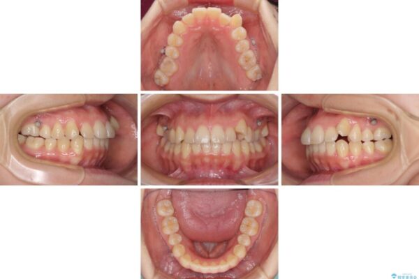 狭い歯列を拡大　拡大装置を併用したインビザライン矯正 治療途中画像