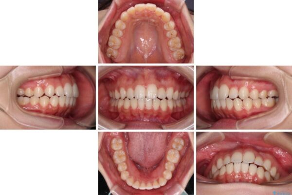 【モニター】前歯のクロスバイトをインビザラインで治療 治療途中画像