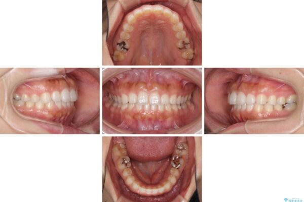 隙間の空いた前歯を閉じたい　インビザライン矯正 治療途中画像
