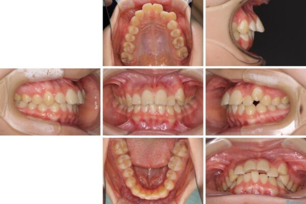 目立つ八重歯を治したい　インビザラインによる矯正治療 治療前画像