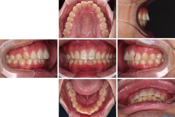 気になる前歯を短期間で改善　下顎の部分矯正と上顎のオールセラミッククラウン 治療前画像