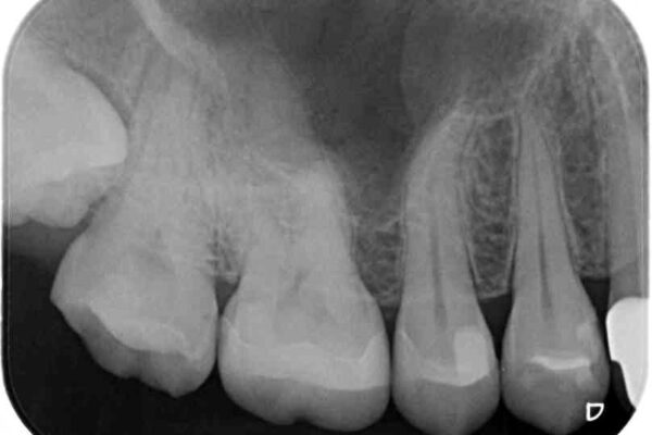抜歯と言われた奥歯を残したい　奥歯を保存するセラミック治療 治療後画像