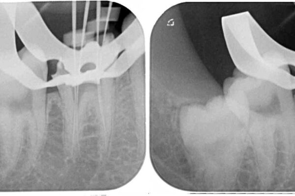 放置した虫歯　根管治療とオールセラミッククラウン 治療途中画像