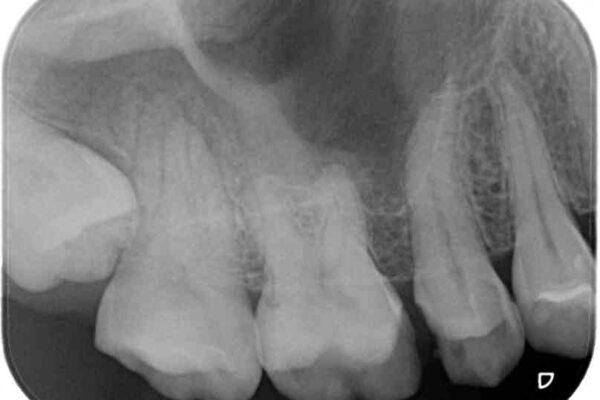 抜歯と言われた奥歯を残したい　奥歯を保存するセラミック治療 治療前画像