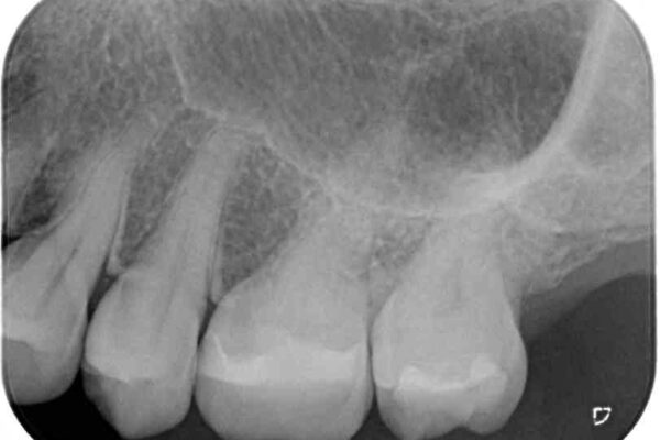 奥歯がしみる　セラミックインレーでの虫歯治療 治療後画像