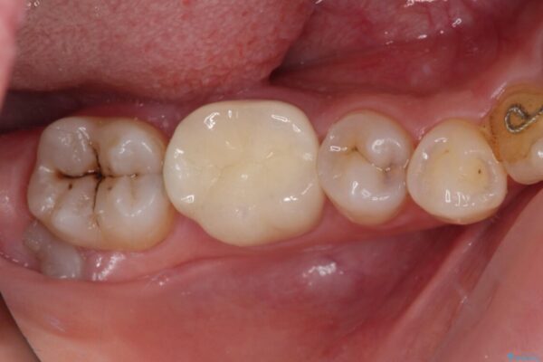放置した虫歯　根管治療とオールセラミッククラウン 治療後画像