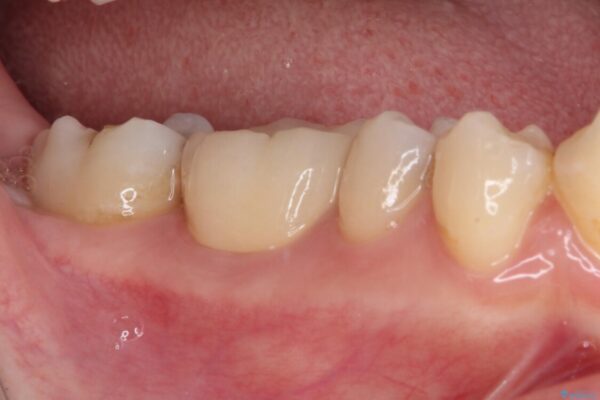 放置した虫歯　根管治療とオールセラミッククラウン 治療後画像