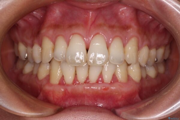 年々下がる歯茎を何とかしたい　歯肉移植術による根面被覆 治療途中画像