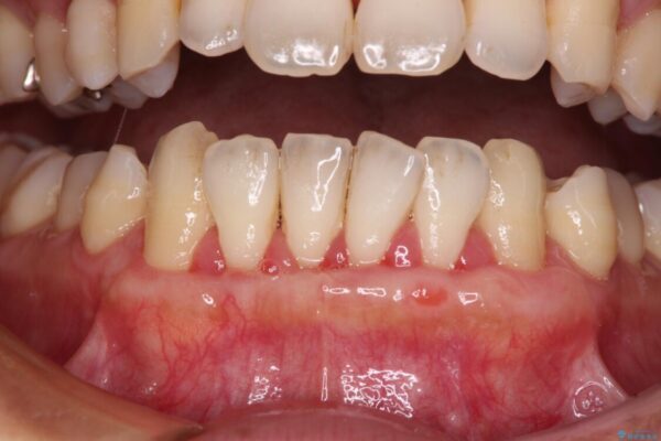 年々下がる歯茎を何とかしたい　歯肉移植術による根面被覆 治療途中画像