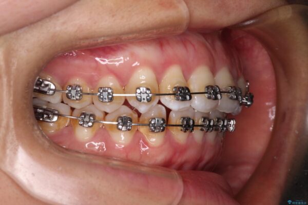 前歯の反対咬合　急速拡大装置とワイヤー装置であっという間の矯正治療 治療途中画像