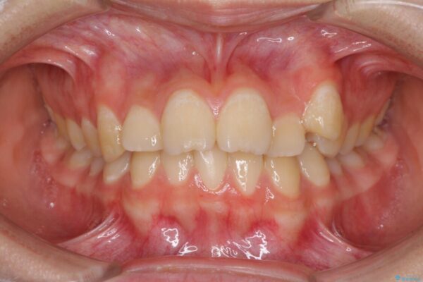 目立つ八重歯を治したい　インビザラインによる矯正治療 ビフォー