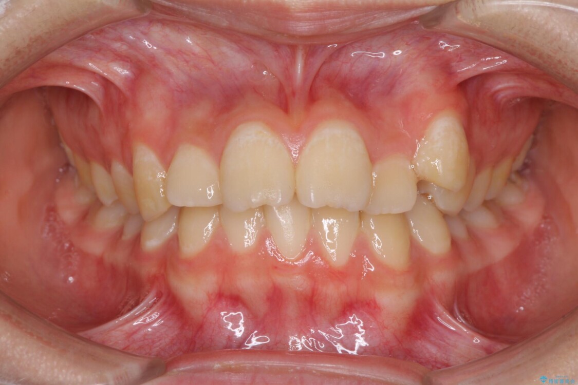 目立つ八重歯を治したい　インビザラインによる矯正治療 治療前