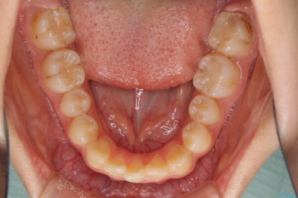 目立つ八重歯を治したい　インビザラインによる矯正治療 治療前画像