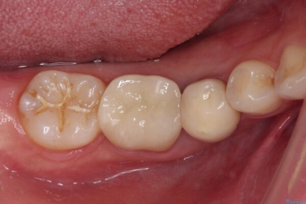 抜歯と言われた奥歯を残したい　奥歯を保存するセラミック治療 アフター