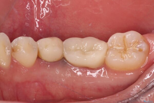抜歯と言われた奥歯を残したい　奥歯を保存するセラミック治療 治療後画像