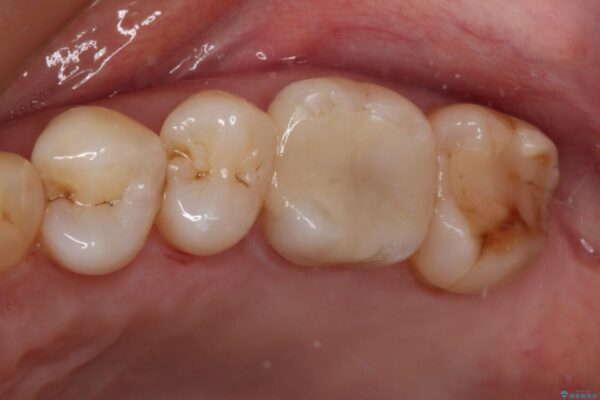 奥歯がしみる　セラミックインレーでの虫歯治療 アフター