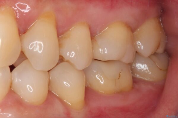 奥歯がしみる　セラミックインレーでの虫歯治療 治療後画像