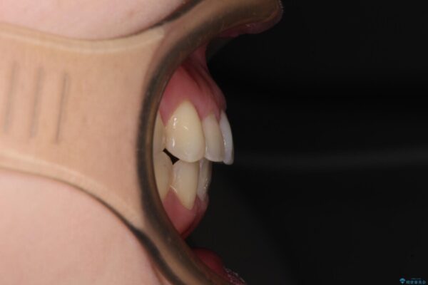 狭い歯列を拡大　拡大装置を併用したインビザライン矯正 治療後画像