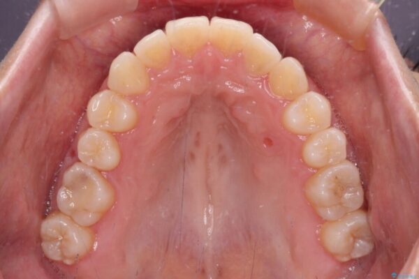 狭い歯列を拡大　拡大装置を併用したインビザライン矯正 治療後画像