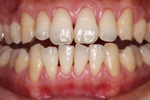 年々下がる歯茎を何とかしたい　歯肉移植術による根面被覆 治療前画像