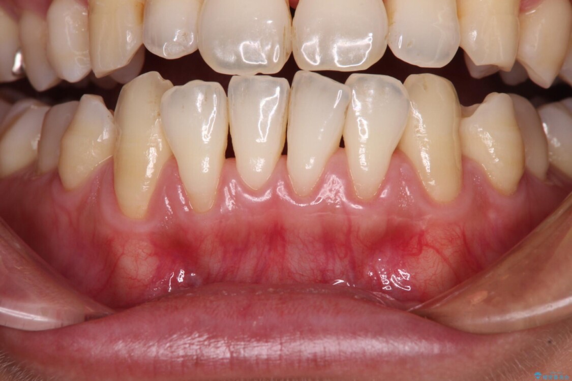 年々下がる歯茎を何とかしたい　歯肉移植術による根面被覆 治療前