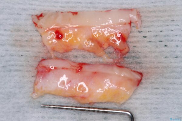 年々下がる歯茎を何とかしたい　歯肉移植術による根面被覆 治療前画像