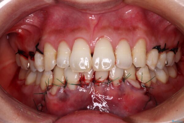 年々下がる歯茎を何とかしたい　歯肉移植術による根面被覆 治療後画像