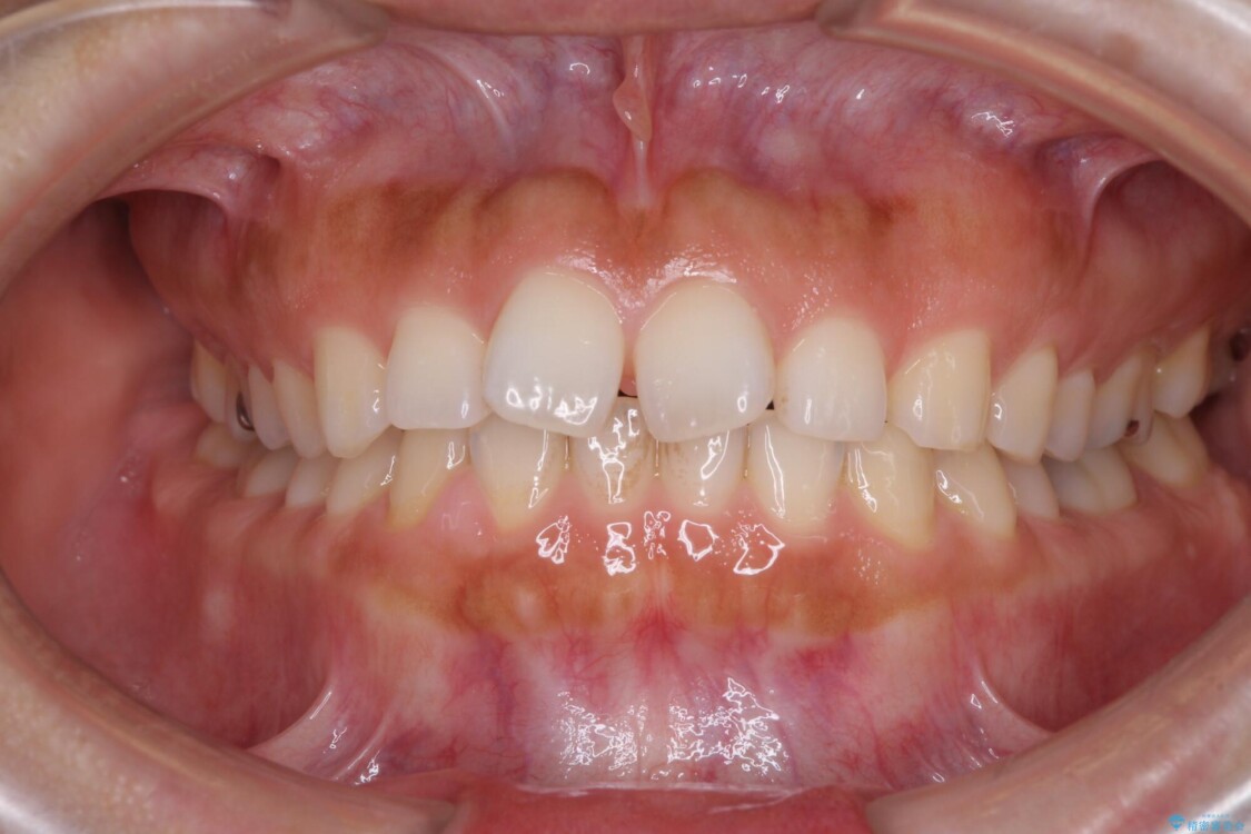 隙間の空いた前歯を閉じたい　インビザライン矯正 治療前