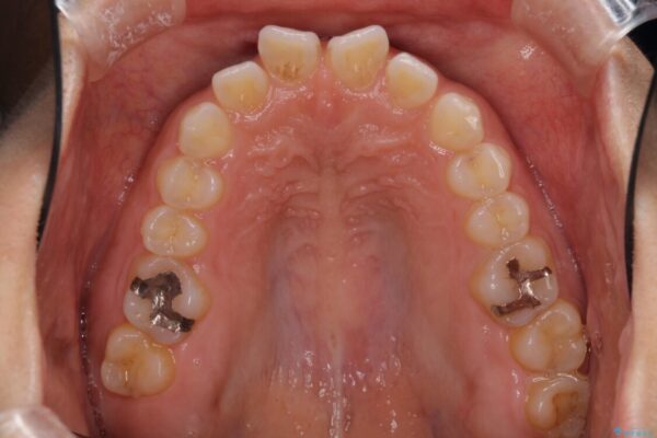 隙間の空いた前歯を閉じたい　インビザライン矯正 治療前画像