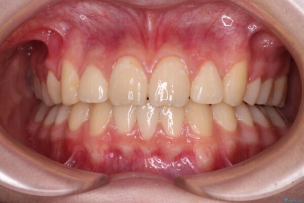 目立つ八重歯を治したい　インビザラインによる矯正治療 アフター