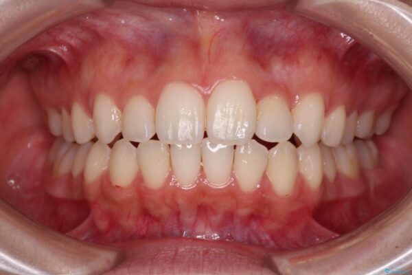 【モニター】前歯のクロスバイトをインビザラインで治療 治療途中画像