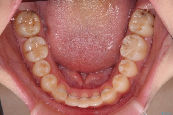目立つ八重歯を治したい　インビザラインによる矯正治療 治療後画像
