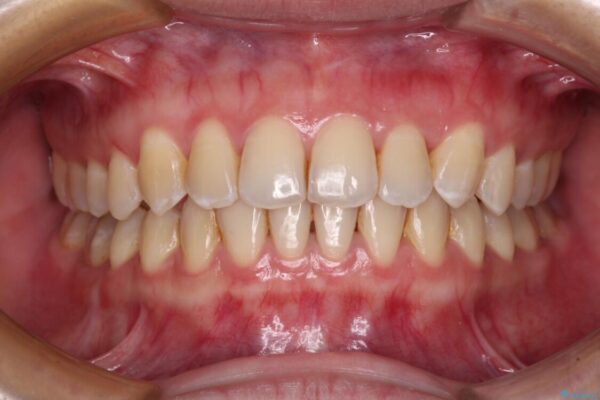 前歯の反対咬合　急速拡大装置とワイヤー装置であっという間の矯正治療 アフター