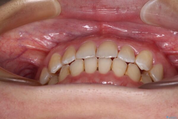 前歯の反対咬合　急速拡大装置とワイヤー装置であっという間の矯正治療 治療後画像