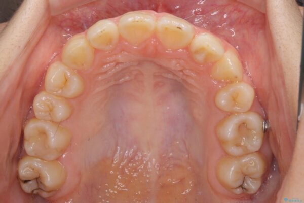 目立つ八重歯を治したい　インビザラインによる矯正治療 治療途中画像