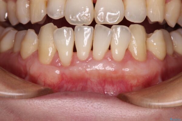 年々下がる歯茎を何とかしたい　歯肉移植術による根面被覆 治療後画像