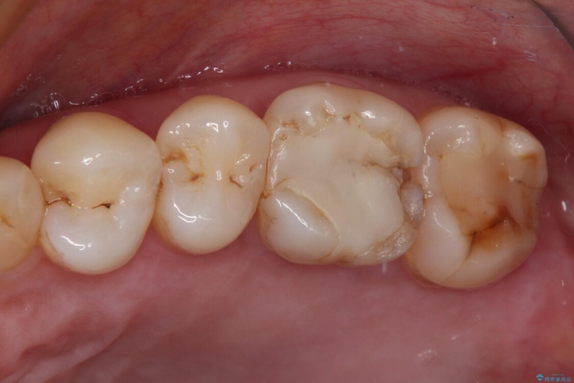 奥歯がしみる　セラミックインレーでの虫歯治療 治療前