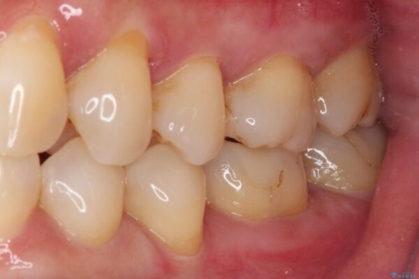 奥歯がしみる　セラミックインレーでの虫歯治療 治療前画像