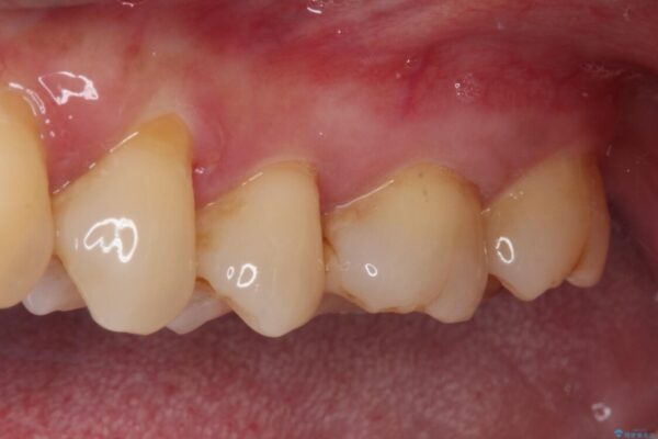 奥歯がしみる　セラミックインレーでの虫歯治療 治療前画像