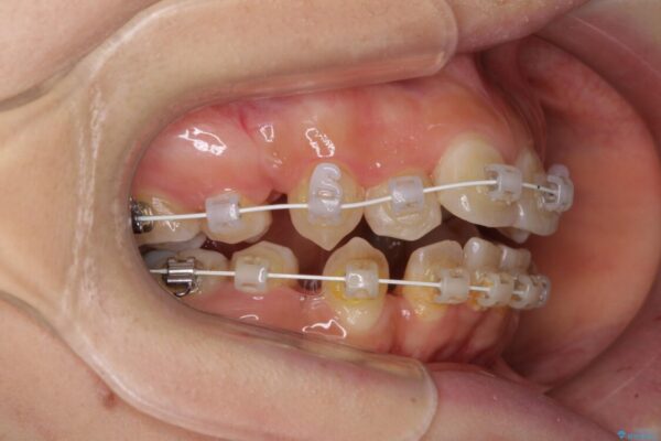見えないほど重なっている前歯　抜歯矯正でスッキリとした歯並びに 治療途中画像